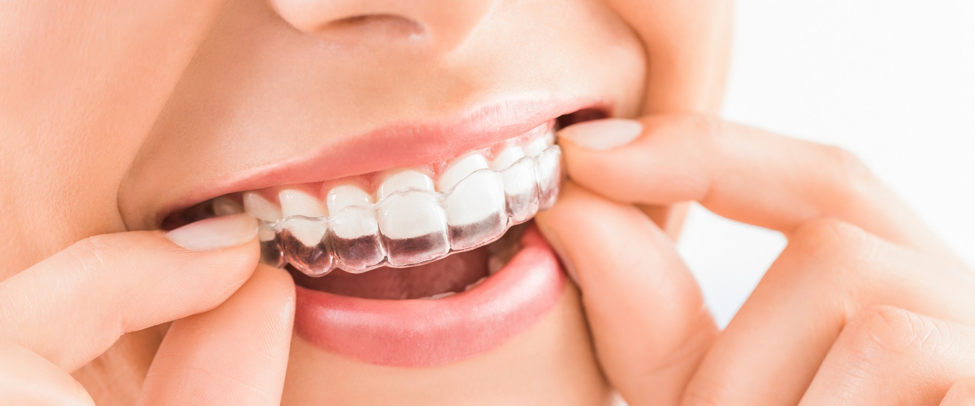 How to Clean Your Invisalign Aligners A StepbyStep Guide