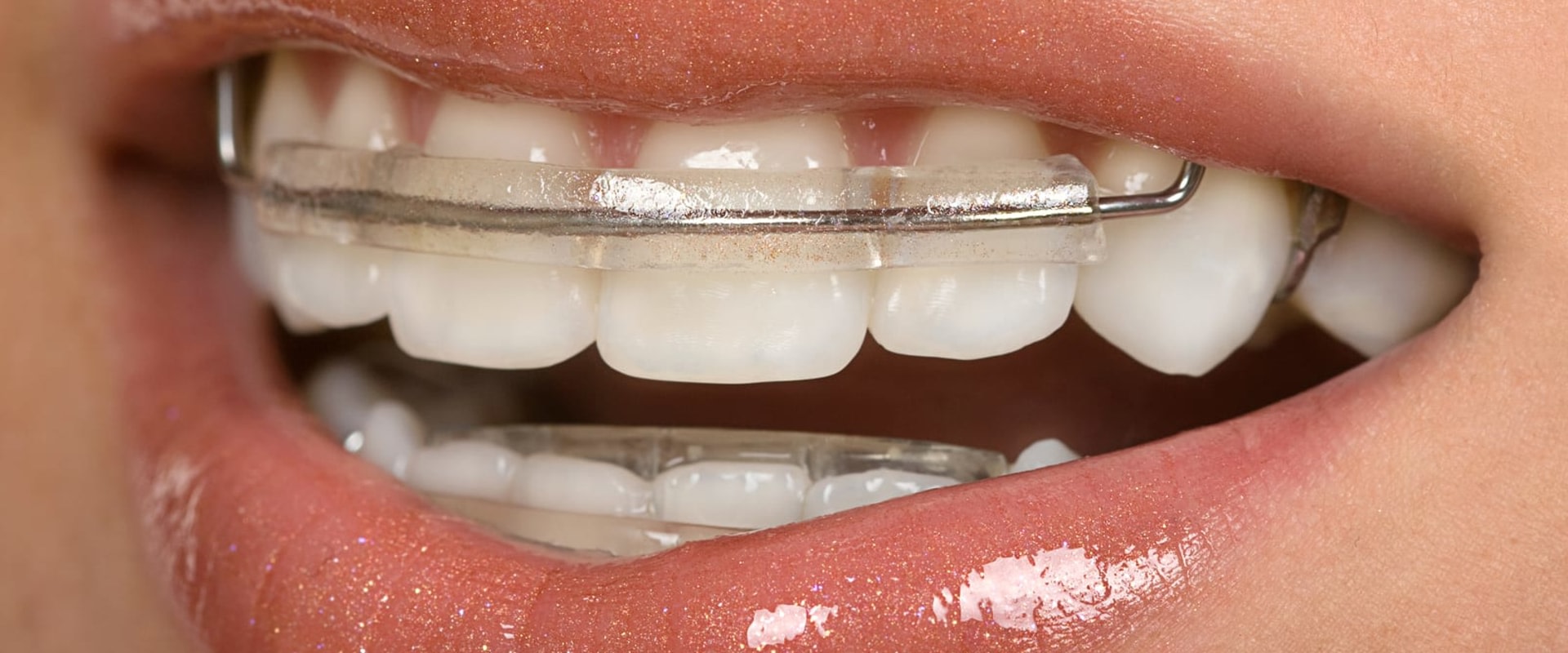Do You Have to Wear a Retainer Full Time After Invisalign?