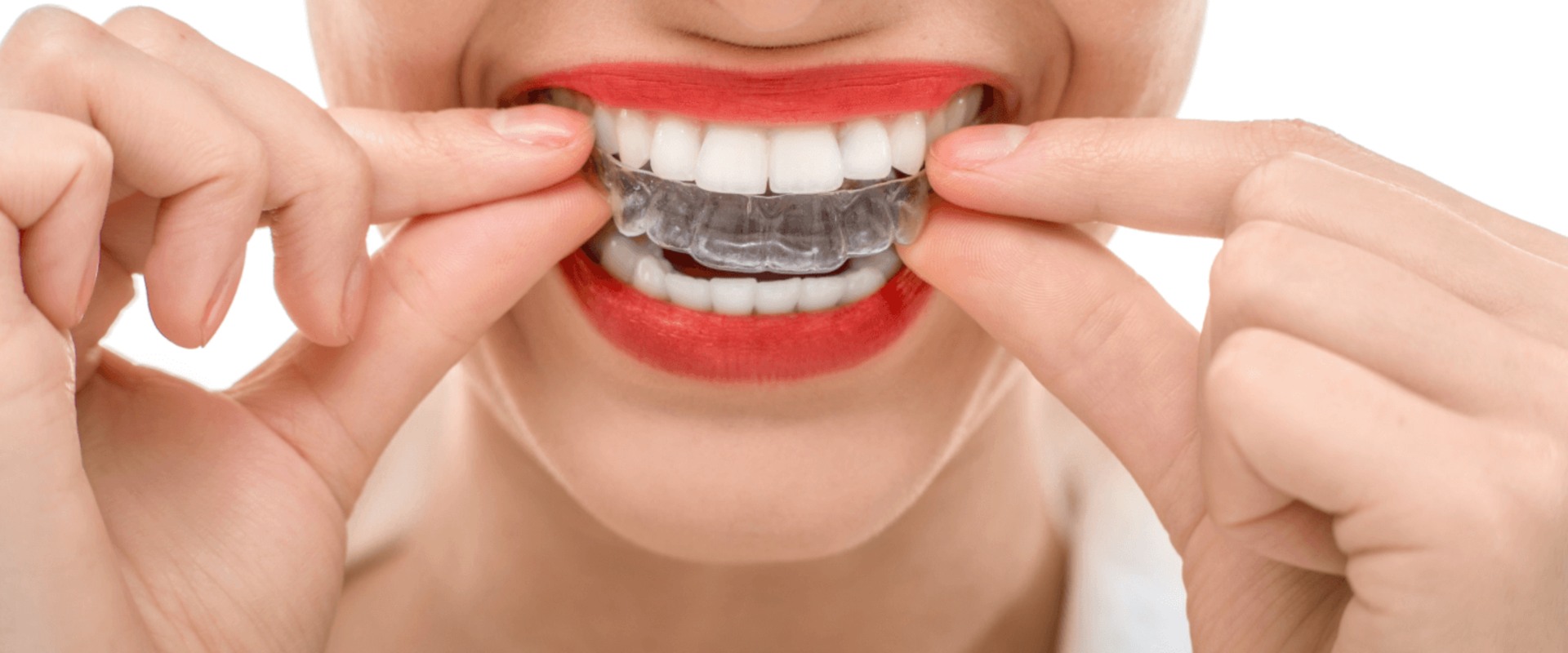 Can Invisalign Move Teeth in 2 Weeks?