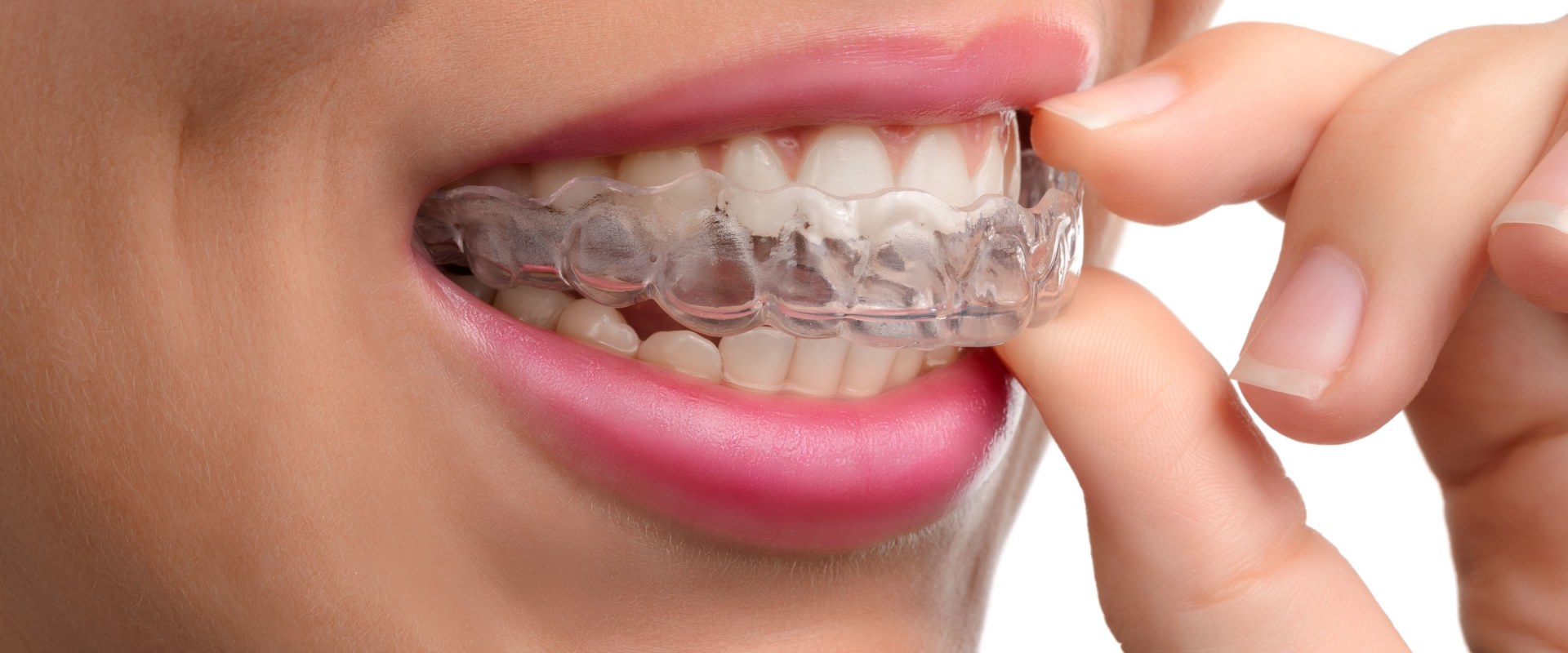 What to Do When Invisalign Doesn't Work