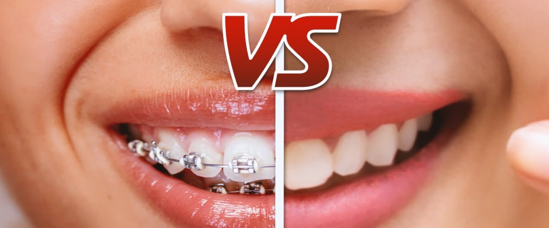 Is Invisalign Better Than Regular Braces?