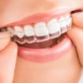 How Long Does It Take to Straighten Teeth with Invisalign?