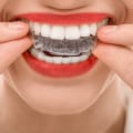 How Long Does It Take for Invisalign to Work?
