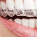 How Long Does Invisalign Take to Fully Work?