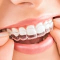How to Clean Your Invisalign Aligners: A Step-by-Step Guide