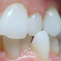 Can Invisalign Straighten Your Teeth in 3 Months?