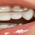 Do You Have to Wear a Retainer Full Time After Invisalign?