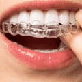 Getting Started with Invisalign Treatment: A Step-by-Step Guide