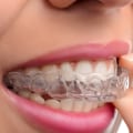 What is the Difference Between Invisalign and Traditional Braces?