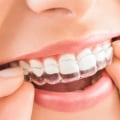 What is Invisalign and How Does it Work?