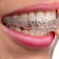 Does Invisalign Work Permanently?