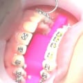 What Happens After Invisalign Treatment is Over?