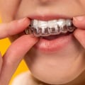 The Benefits of Invisalign Over Braces