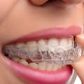 Why Invisalign is Better than Traditional Braces