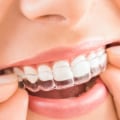 What to Expect at Your First Invisalign Appointment