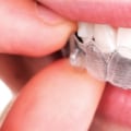 Can I Use Mouthwash While Wearing My Invisalign Aligners?
