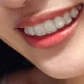What Happens When Invisalign Comes Off?