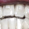 What is Invisalign and How Does it Work?