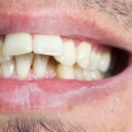 What Types of Cases Can Invisalign Treat?
