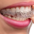 Caring for Your Roof of the Mouth While Wearing Invisalign Aligners