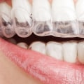 What are the Downsides of Invisalign Braces?
