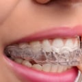 How to Properly Clean Your Invisalign Aligners