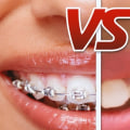 Is Invisalign Better Than Regular Braces?