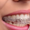 What Foods Should I Avoid While Wearing Invisalign Aligners?