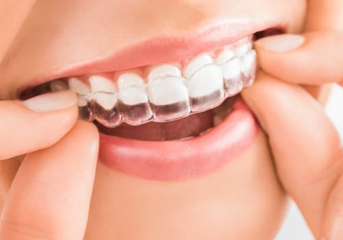 How Long Does It Take to Straighten Teeth with Invisalign?