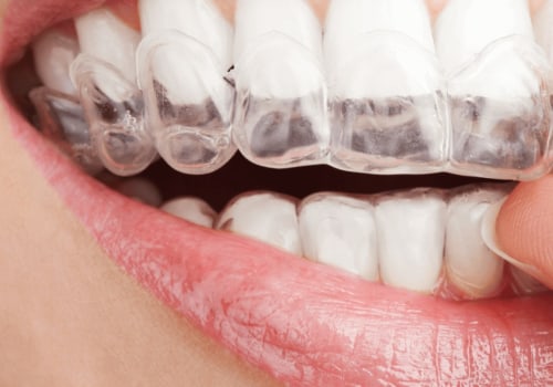 How Long Does Invisalign Take to Fully Work?
