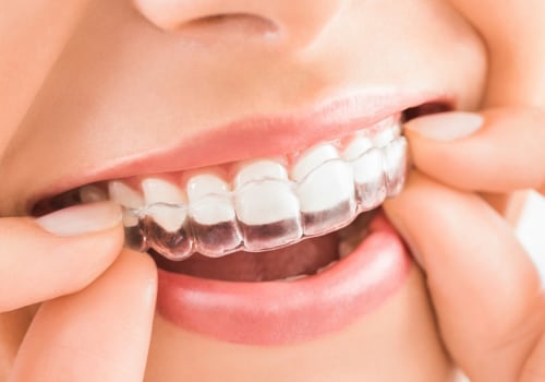 How to Clean Your Invisalign Aligners: A Step-by-Step Guide