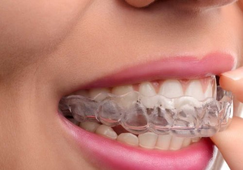 Can I Eat and Drink with My Invisalign Aligners In?