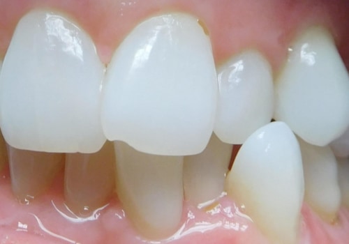 Can Invisalign Straighten Your Teeth in 3 Months?