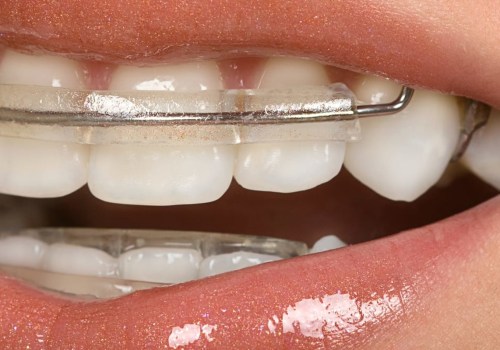 Do You Have to Wear a Retainer Full Time After Invisalign?