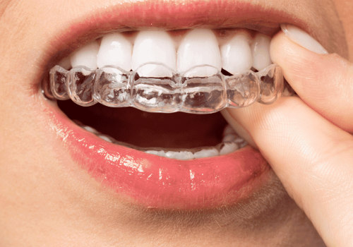 Getting Started with Invisalign Treatment: A Step-by-Step Guide
