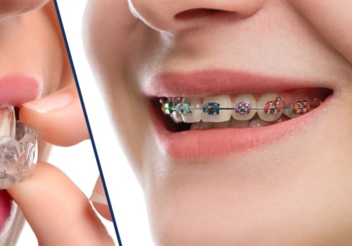 What is the Difference Between Invisalign and Traditional Braces?