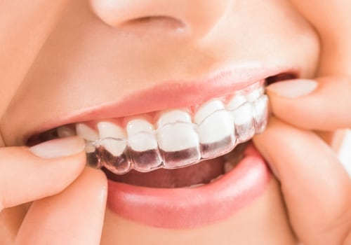 What is Invisalign and How Does it Work?