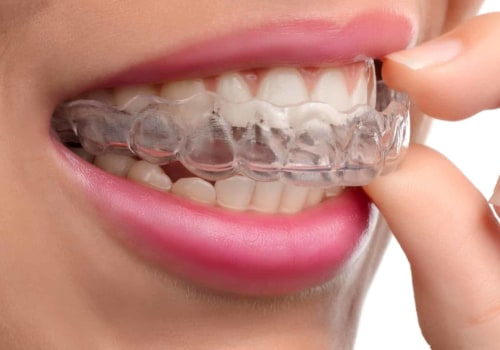 Does Invisalign Work Permanently?