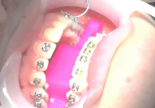 What Happens After Invisalign Treatment is Over?