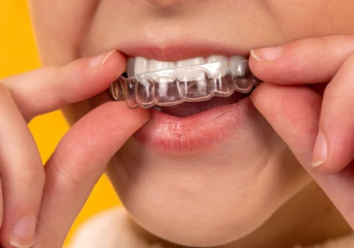 The Benefits of Invisalign Over Braces