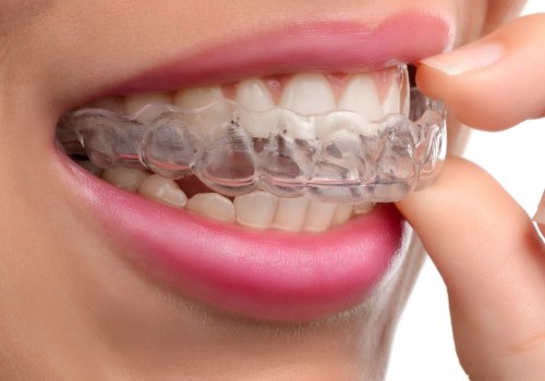 How Long Does It Take to Put Invisalign On?