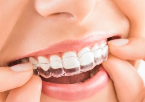How Long Does It Take to Get Invisalign for the First Time?