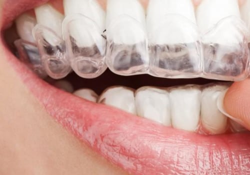Caring for Your Jaw While Wearing Invisalign Aligners: Expert Tips