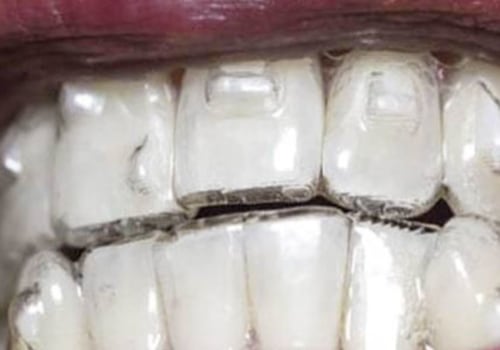 What is Invisalign and How Does it Work?