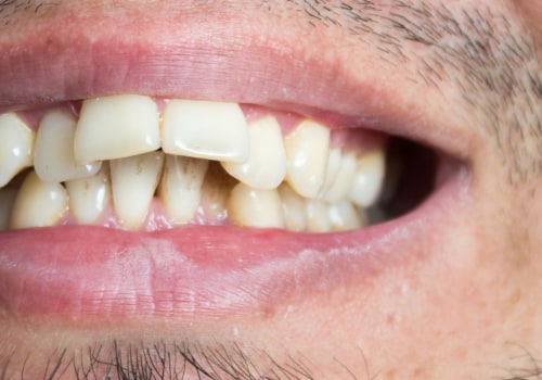 What Types of Cases Can Invisalign Treat?