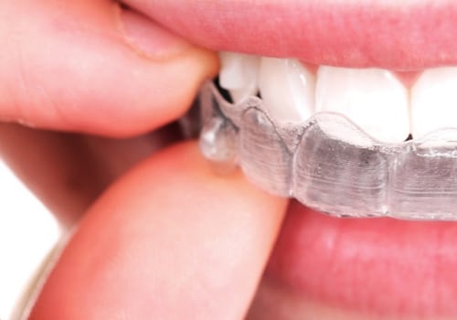 How Long Does it Take to Straighten Teeth with Invisalign?