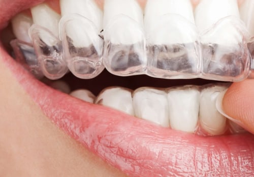 What are the Downsides of Invisalign Braces?