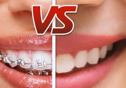 Is Invisalign Better Than Regular Braces?